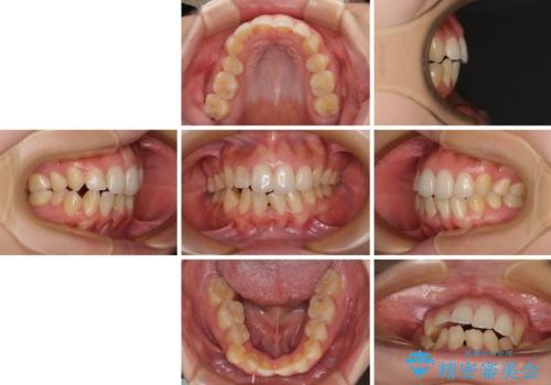 後戻りの再矯正 ワイヤー装置でデコボコと隙間を改善の治療前