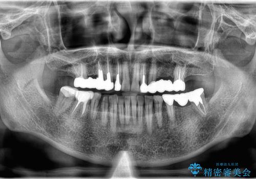 歯肉からの出血 適合の悪い銀歯をオールセラミックのブリッジにやり替えの治療前
