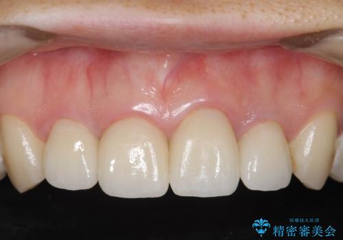 黒っぽい歯ぐきを改善したい　メタルフリーセラミック治療の症例 治療後