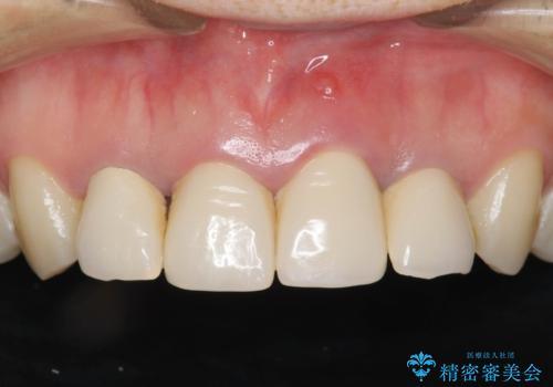 黒っぽい歯ぐきを改善したい　メタルフリーセラミック治療の症例 治療前