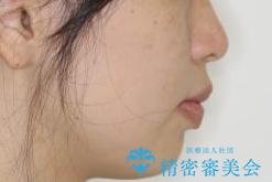 【審美ワイヤー】重度の叢生を治療の治療前(顔貌)
