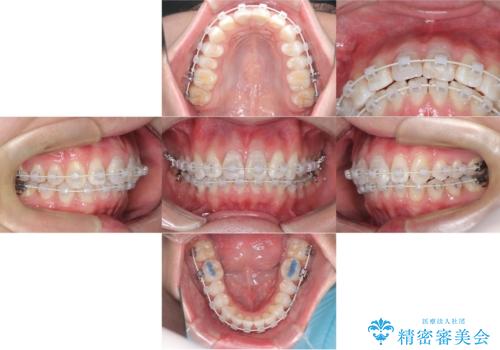 【ワイヤー矯正 11ヵ月で矯正終了!】歯のでこぼこを治したい! の治療中
