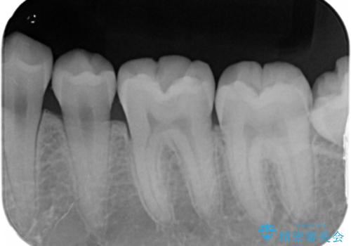 虫歯部分を白い詰め物で治したいの治療後