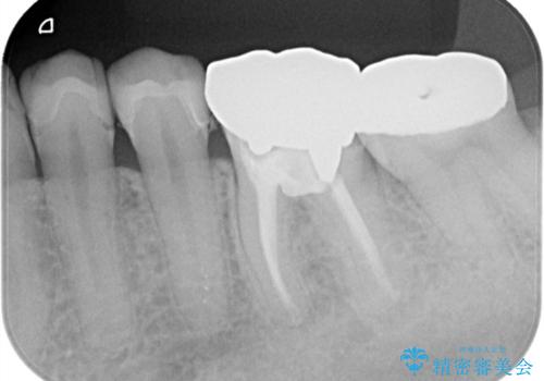 【セラミックインレー】銀の詰め物を白くしていきたいの治療後