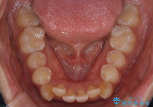 【クリア装置】八重歯の矯正治療の治療前