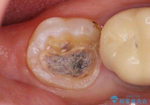 割れたセラミック下に再発した虫歯の治療中