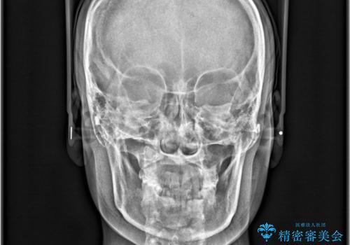 【インビザライン、10ヵ月で矯正終了!】下の前歯が斜めになっているのを治したい!の治療前