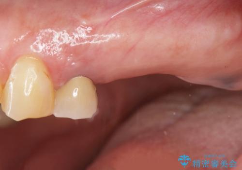 奥歯がない　咬合力を回復するインプラント治療の症例 治療前