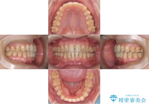 【インビザライン、10ヵ月で矯正終了!】下の前歯が斜めになっているのを治したい!の治療中
