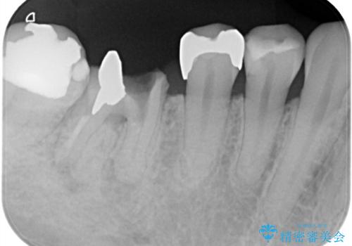 虫歯で失ってしまった奥歯、インプラント治療で再び噛めるように!の治療前