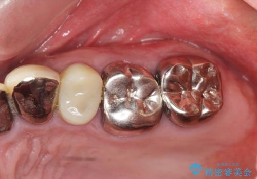 銀歯を外し、インプラントを入れたいの治療前