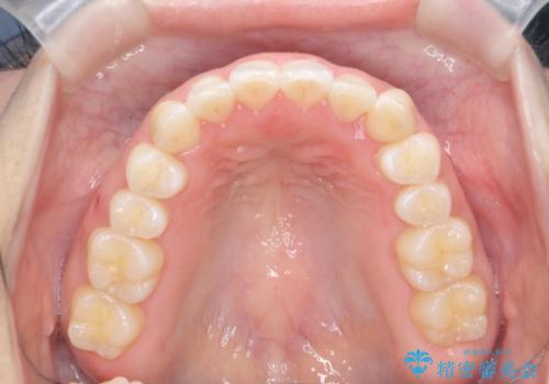 八重歯を非抜歯で マウスピースで治療 奥歯を後ろに下げてすき間を確保の治療後