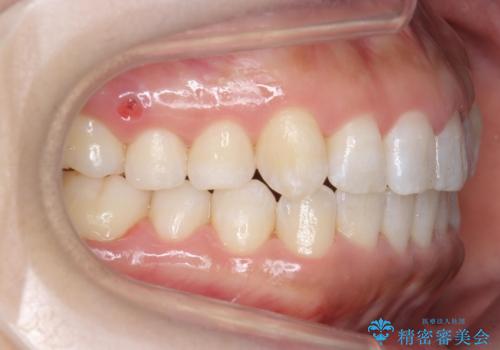 八重歯を非抜歯で マウスピースで治療 奥歯を後ろに下げてすき間を確保の治療後