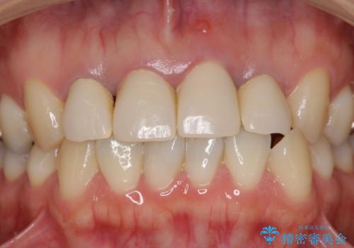 黒っぽい歯ぐきを改善したい　メタルフリーセラミック治療の治療前
