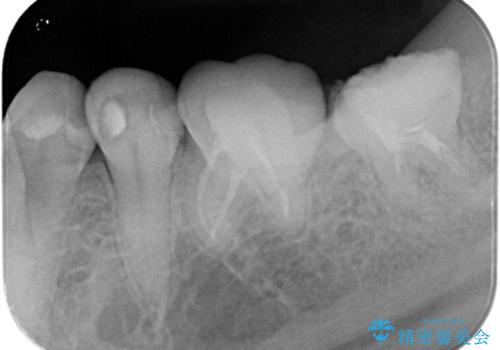 【根管治療】他院でインプラントの提案があった。奥歯が痛い。の治療前