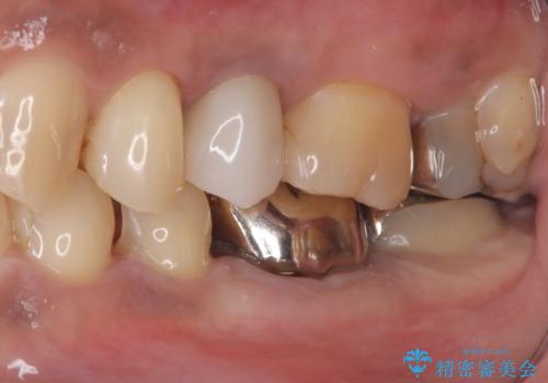 【セラミックインレー】銀の詰め物を白くしていきたいの治療中