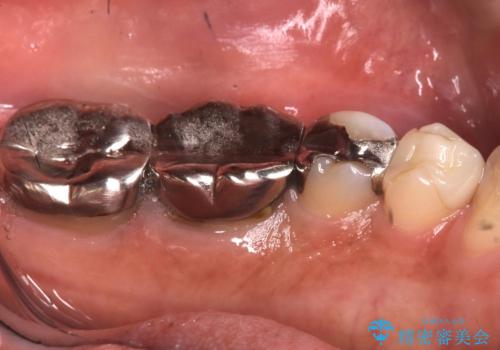 【セラミックインレー】銀の詰め物を白くしていきたいの治療前