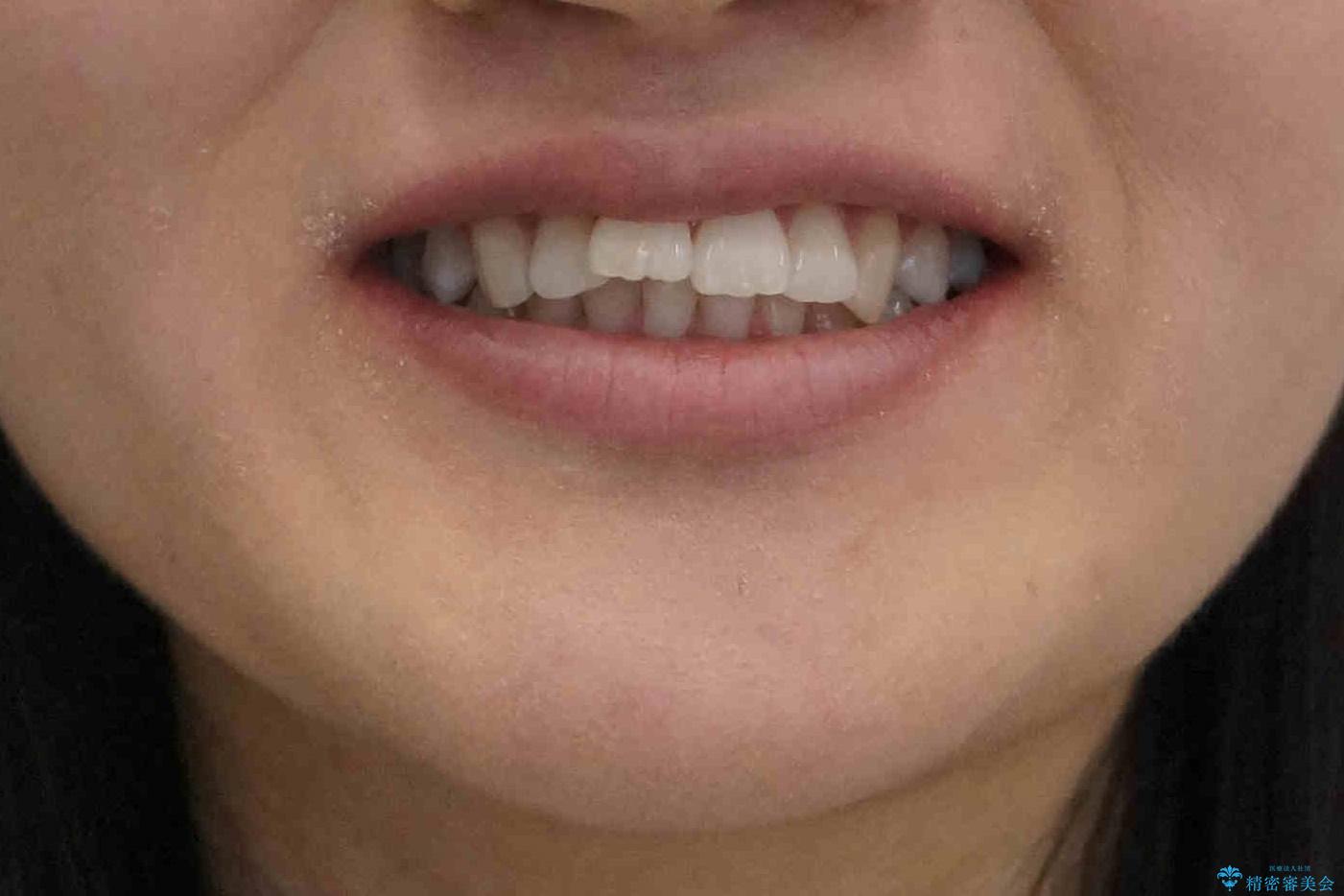 歯を抜かないで出っ歯を治したいの治療前(顔貌)