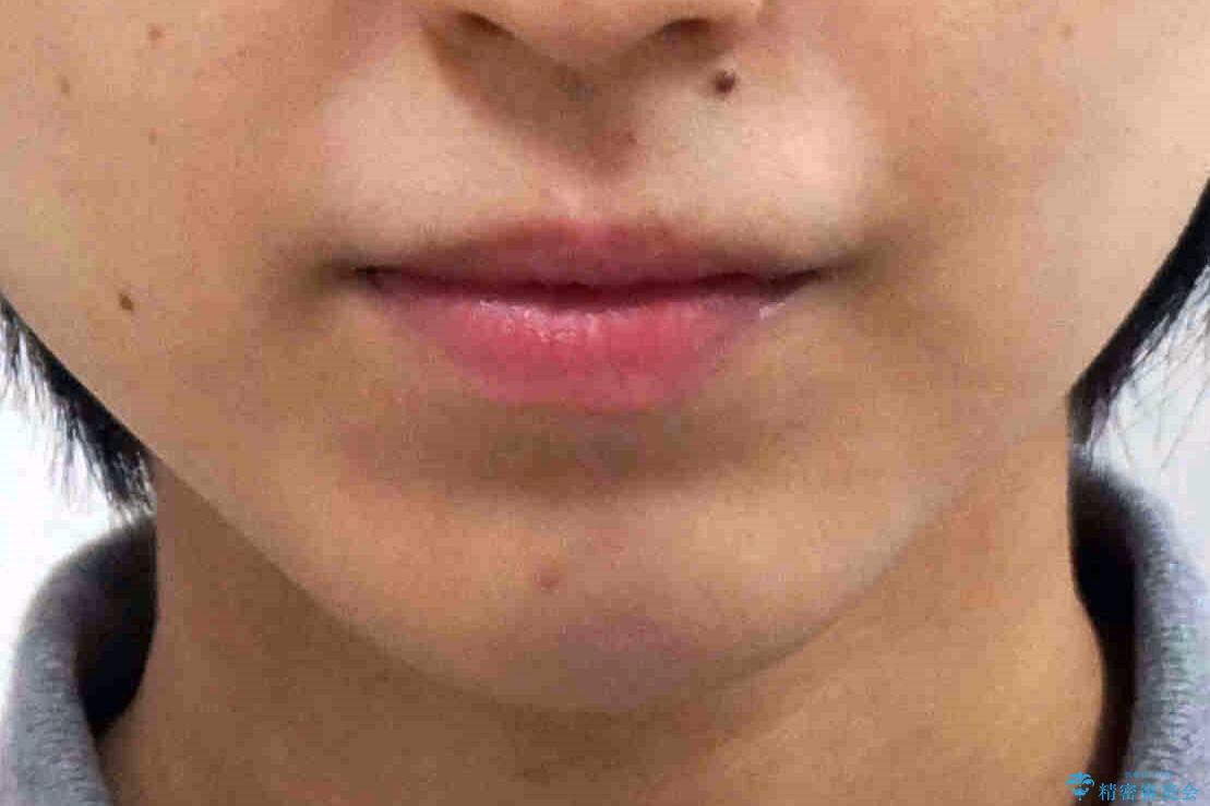 八重歯を非抜歯で マウスピースで治療 奥歯を後ろに下げてすき間を確保の治療前(顔貌)