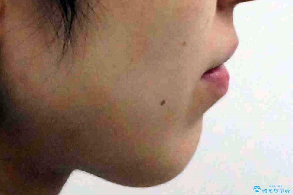 八重歯を非抜歯で マウスピースで治療 奥歯を後ろに下げてすき間を確保の治療前(顔貌)