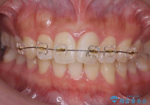 [ ワイヤー小矯正+マウスピース矯正 ]  前歯のねじれを短期間で治したいの治療前