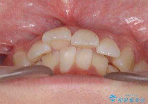歯を抜かないで出っ歯を治したいの治療前