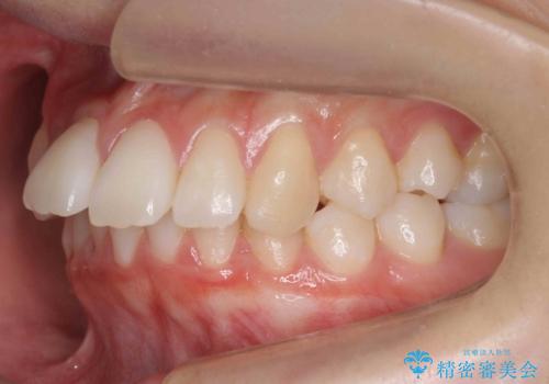歯を抜かないで出っ歯を治したいの治療前
