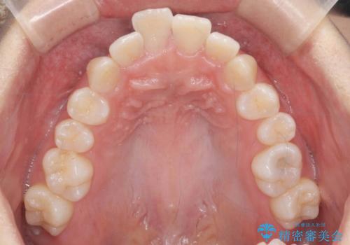 歯を抜かないで出っ歯を治したいの治療前