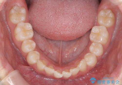 歯を抜かないで出っ歯を治したいの治療前