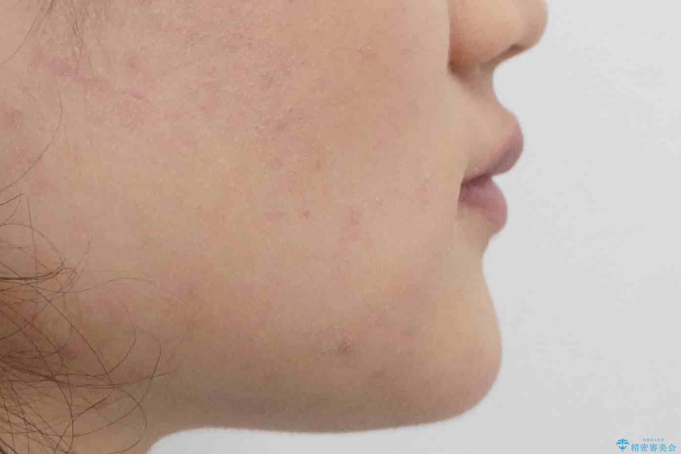 歯を抜かないで出っ歯を治したいの治療前(顔貌)