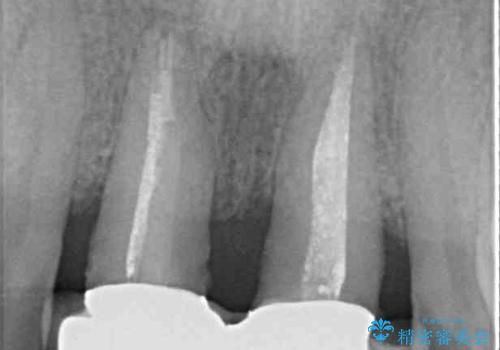 隙間をセラミックで閉じたら不格好で歯肉から出血　矯正治療と歯周外科で綺麗な前歯にの治療前