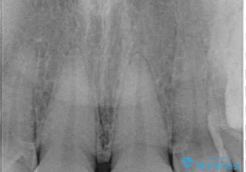 前歯を綺麗にしたい 部分矯正とセラミック治療の治療前