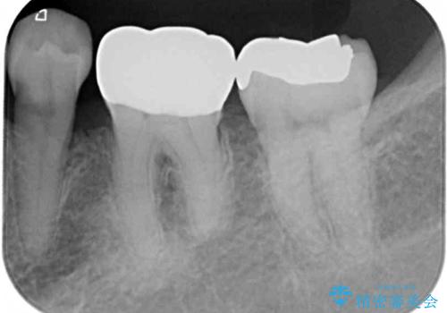 奥歯の目立つ銀歯をセラミックに　オールセラミッククラウン治療の治療前