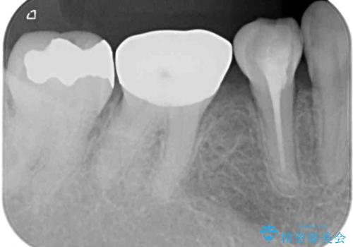 奥歯の目立つ銀歯をセラミックに　オールセラミッククラウン治療の治療前