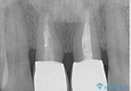 隙間をセラミックで閉じたら不格好で歯肉から出血 矯正治療と歯周外科で綺麗な前歯にの治療後