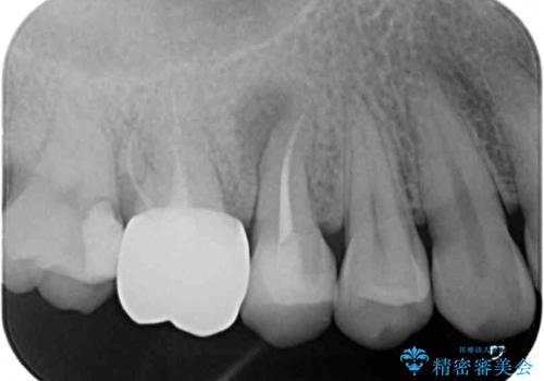 不快感の強い奥歯 オールセラミッククラウンでのむし歯治療の治療前
