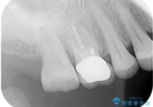 1DAYインプラント 破折して痛みの強い歯 抜歯即時埋入で抜歯した日に仮歯を装着の治療前