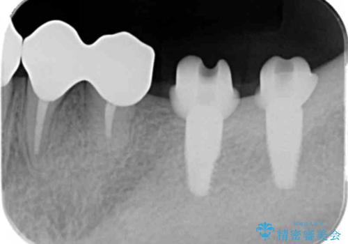 銀歯を外し、インプラントを入れたいの治療中