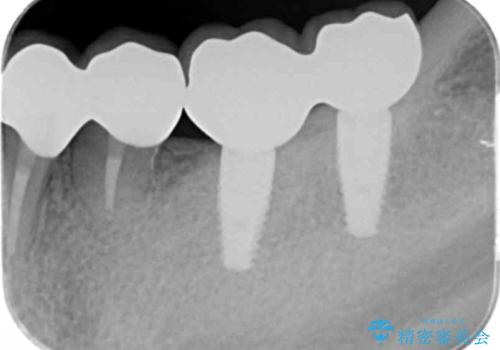 銀歯を外し、インプラントを入れたいの治療後