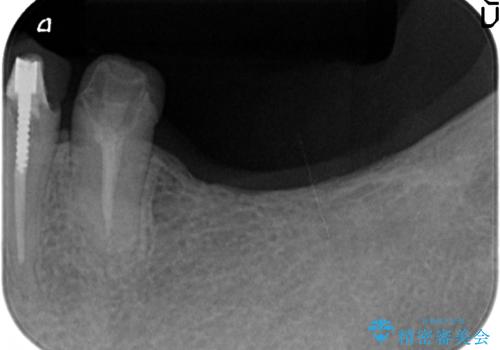 銀歯を外し、インプラントを入れたいの治療前