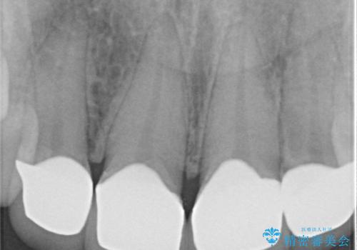 前歯を綺麗にしたい 部分矯正とセラミック治療の治療後