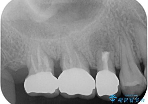 不快感の強い奥歯 オールセラミッククラウンでのむし歯治療の治療後