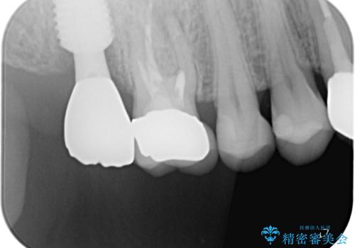 1DAYインプラント 破折して痛みの強い歯 抜歯即時埋入で抜歯した日に仮歯を装着の治療後