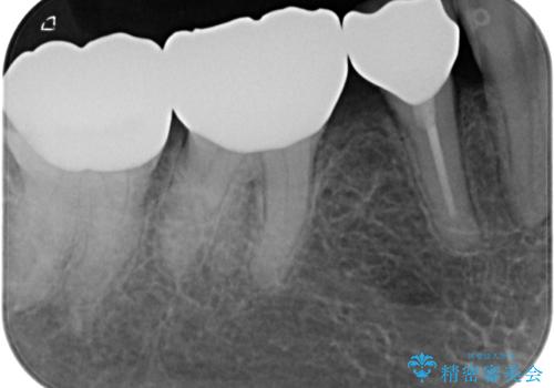 奥歯の目立つ銀歯をセラミックに オールセラミッククラウン治療の治療後