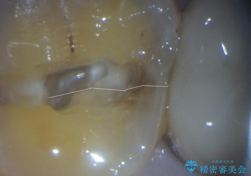 1DAYインプラント 破折して痛みの強い歯 抜歯即時埋入で抜歯した日に仮歯を装着の治療中