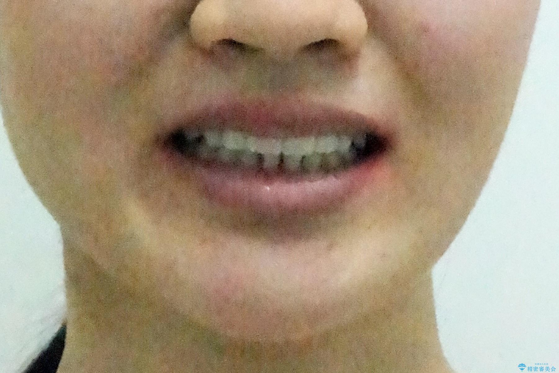 歯を抜かないで出っ歯を治したいの治療後(顔貌)