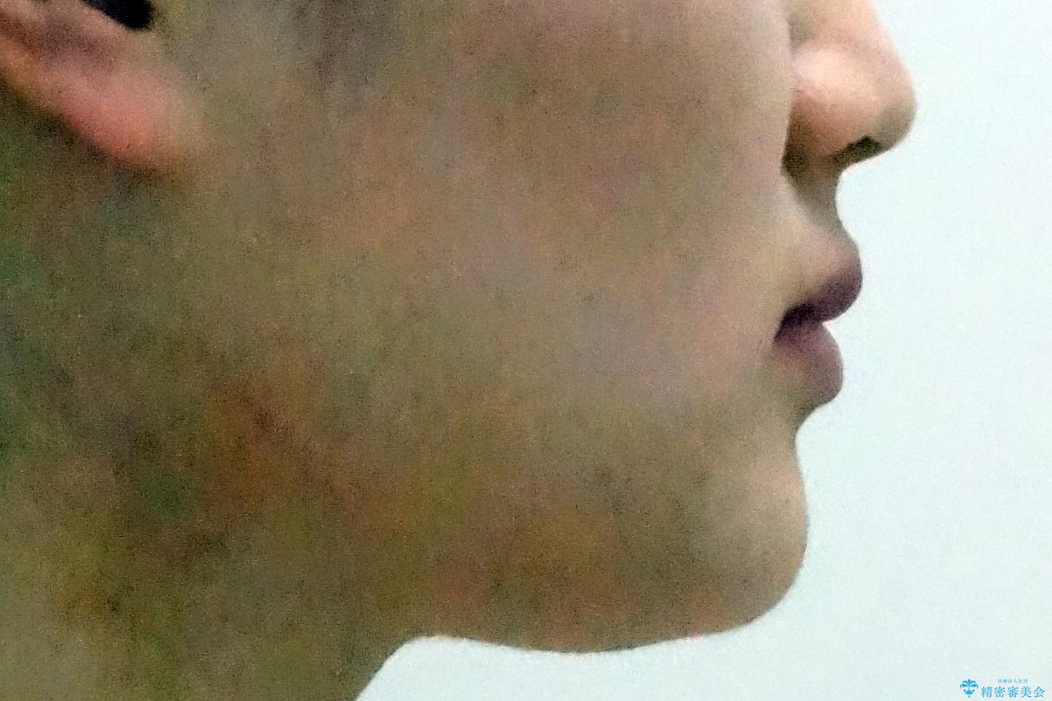 歯を抜かないで出っ歯を治したいの治療後(顔貌)