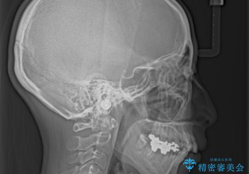 飛び出した上顎前歯とむし歯の多い歯列 目立たないハーフリンガル矯正とむし歯治療の治療前
