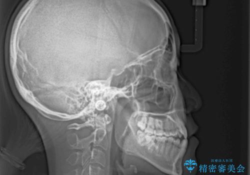 八重歯とオープンバイト 急速拡大装置を用いた矯正治療の治療前