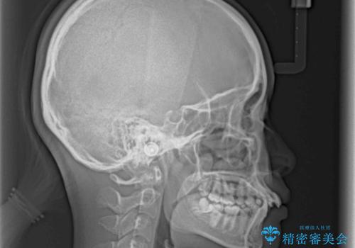 飛び出した上顎前歯 ワイヤー装置にて抜歯矯正治療の治療前